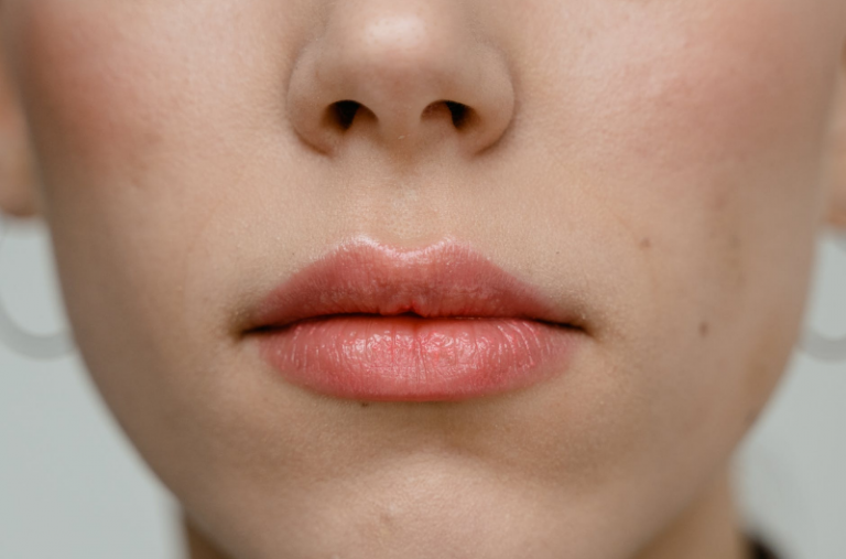 Small Bumps on Lips Fordyce Spots and How to Treat Them Maximum